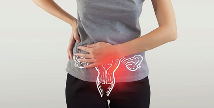 همه چیز درباره سندرم تخمدان پلی کیستیک